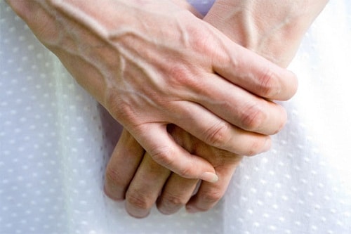 Gân xanh nổi trên tay là một trong những biểu hiện cụ thể nhất của bệnh