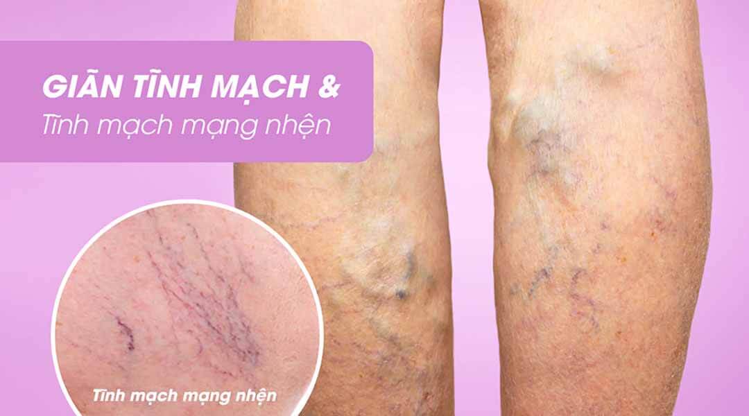 Nguyên nhân gây nên tình trạng giãn tĩnh mạch và cách điều trị bệnh sao cho hiệu quả