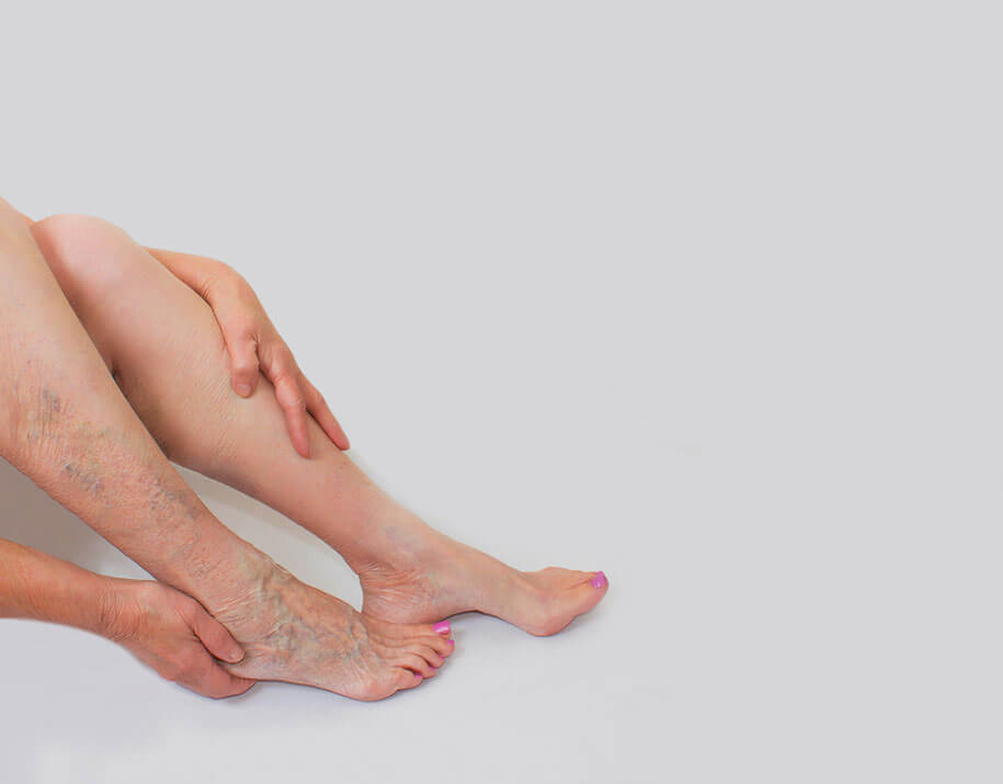 Suy tĩnh mạch chân có thể chữa trị dứt điểm nếu bạn biết cách