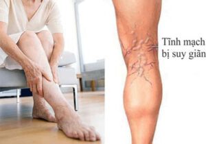 Suy giãn tĩnh mạch chân là gì và cách điều trị bệnh hiệu quả